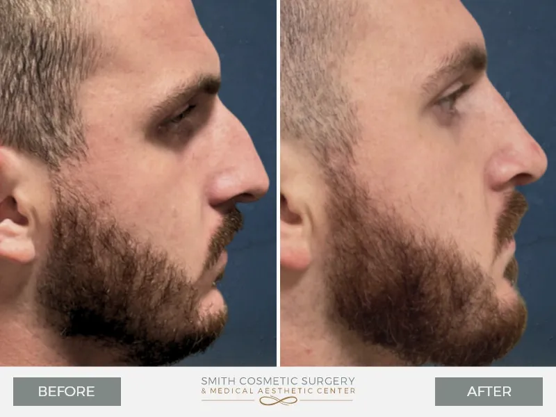 04-Rhinoplasty.jpg