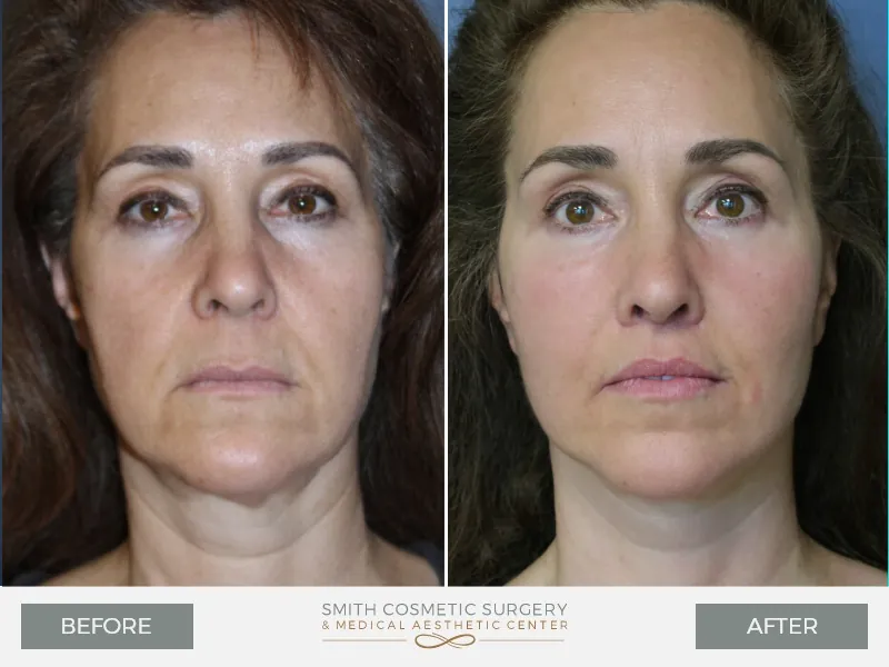 04_Facelift.jpg
