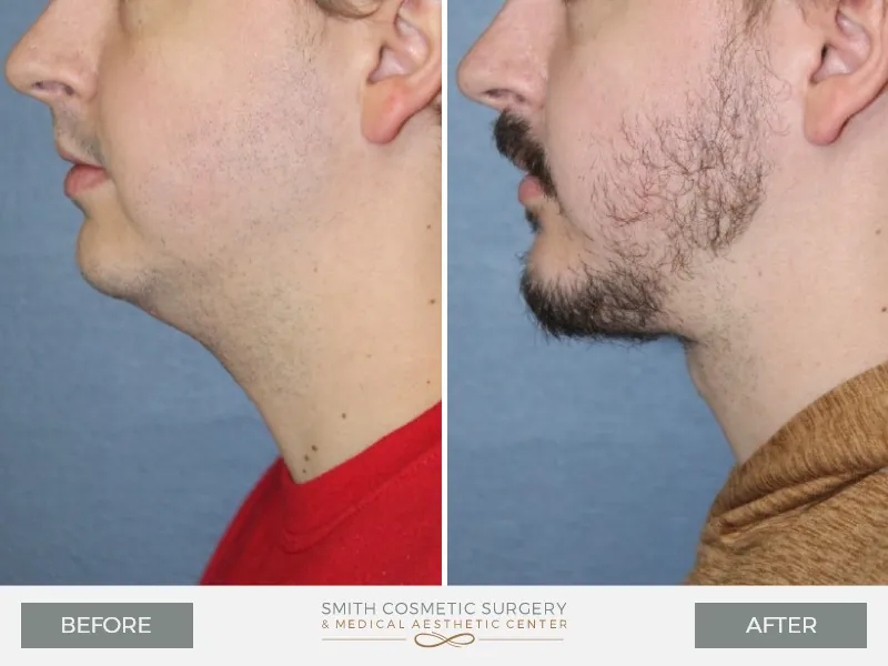 04_chin_surgery_before_and_after.jpg