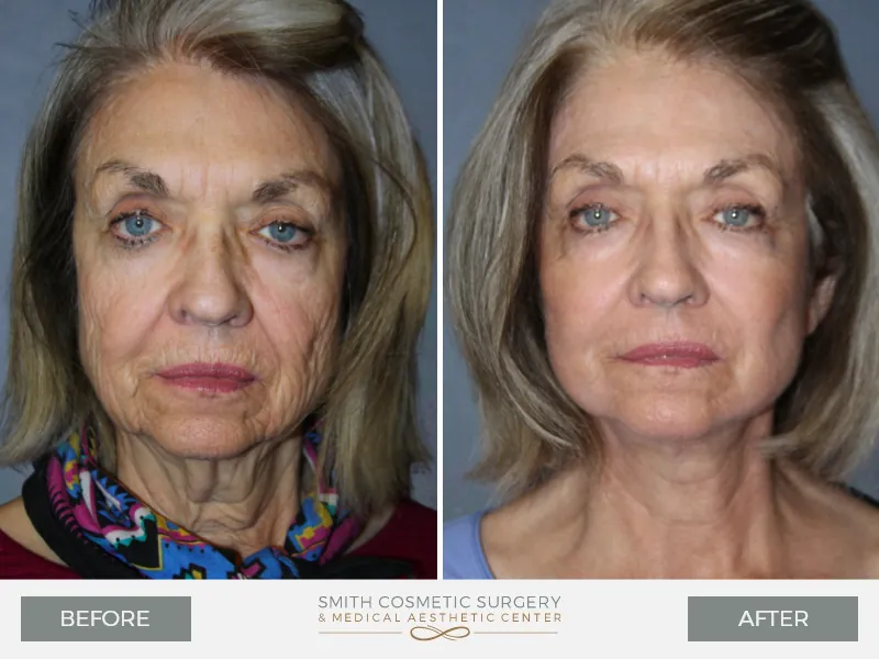 04_laser_resurfacing_before_and_after.jpg