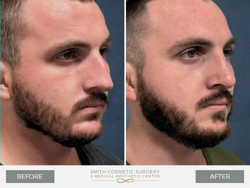 05-Rhinoplasty.jpg