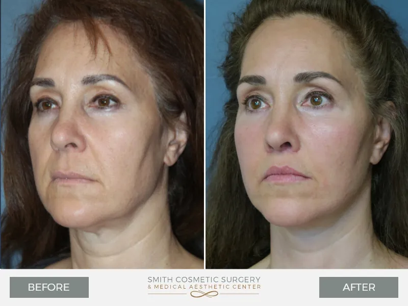 05_Facelift.jpg