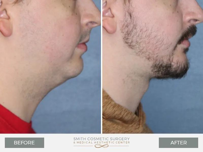05_chin_surgery_before_and_after.jpg