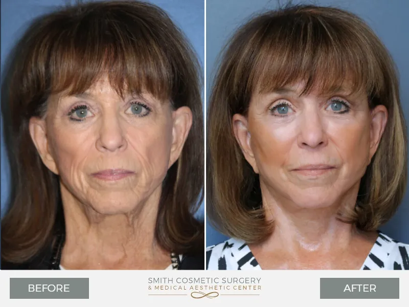 07_Facelift.jpg