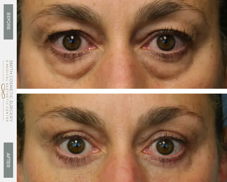 1-Eyelid-Lift-and-Brow-Lift-1.jpg