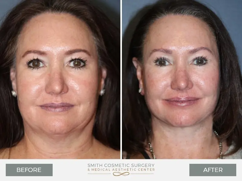 3-face-lift-before-after.jpg