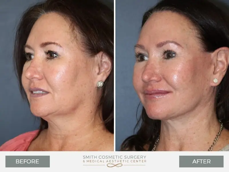 4-face-lift-before-after.jpg