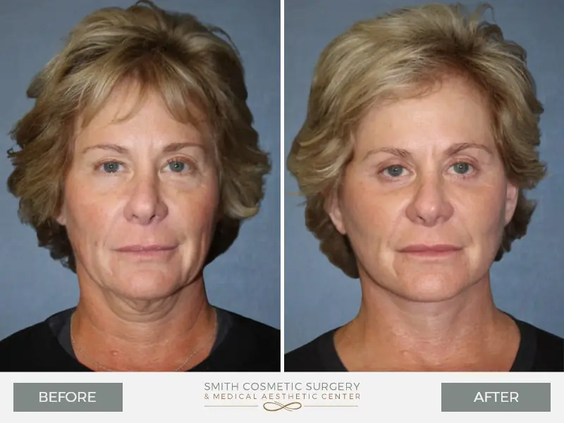 5-face-lift-before-after.jpg