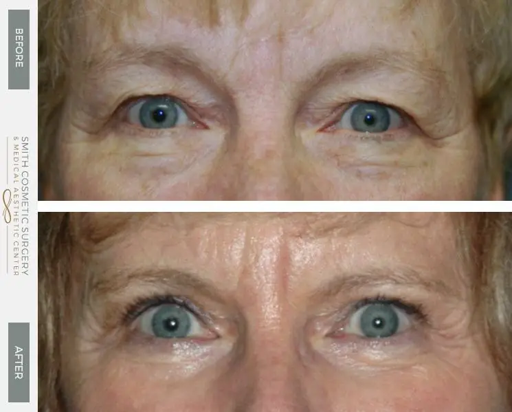 AH-Eyelid-and-Brow-Lift-Front.jpg