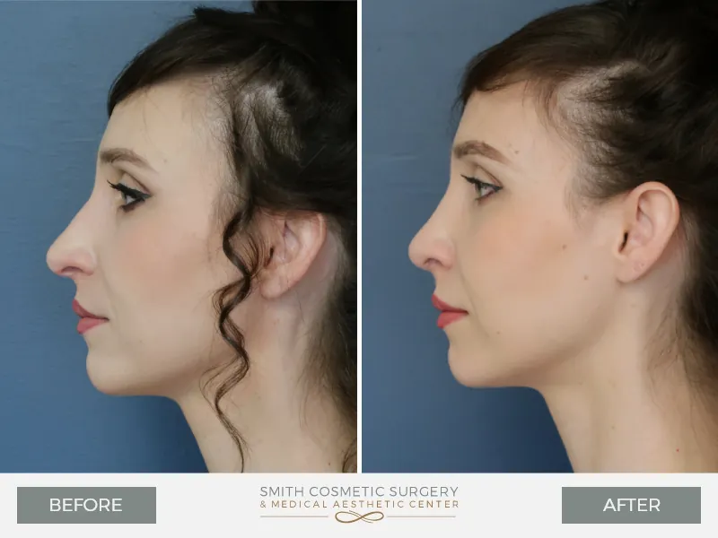AS-Rhinoplasty-Lateral-Left.jpg