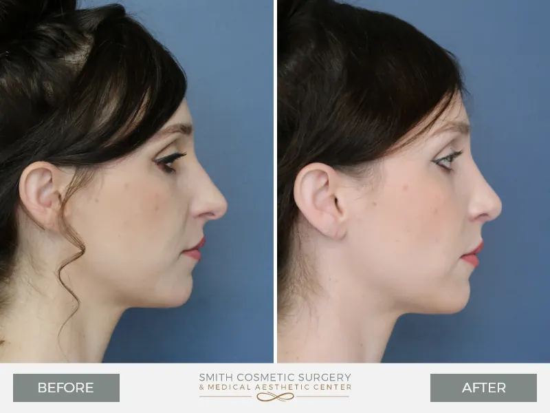 AS-Rhinoplasty-Lateral-Right.jpg