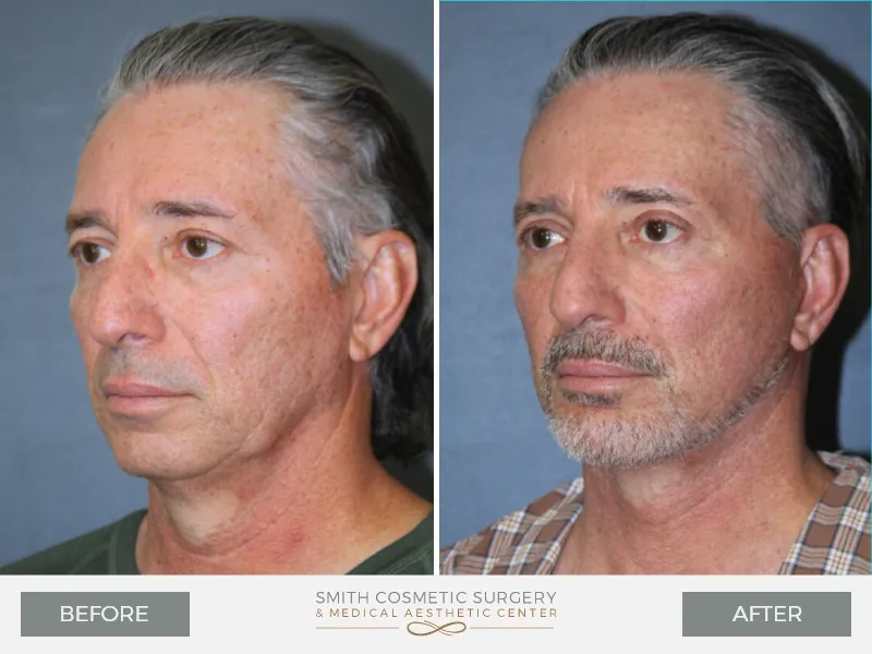 Before_After_Facelift_Male-ob.jpg