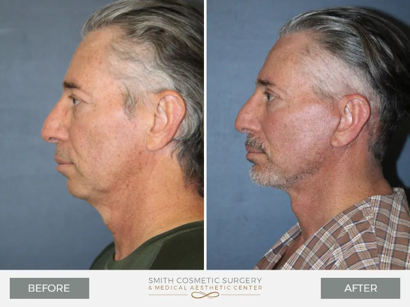 Before_After_Facelift_Male_side.jpg