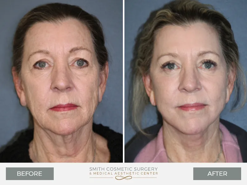 Before_And_After_AD_Facelift-front.jpg