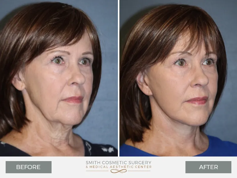 Mini Facelift Recovery and Results