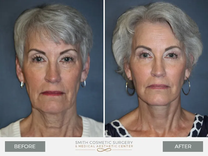 Before_and_After_MM_Facelift_front.jpg