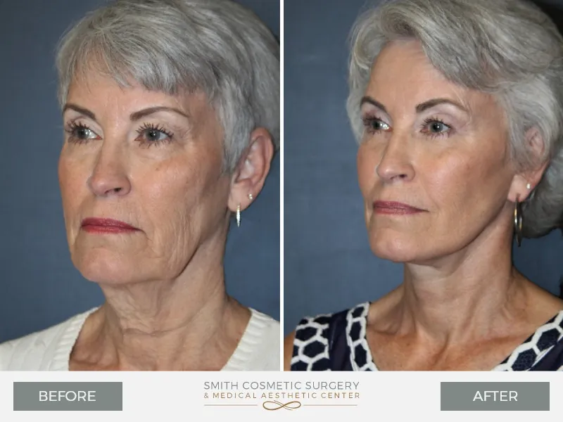 Before_and_After_MM_Facelift_ob.jpg