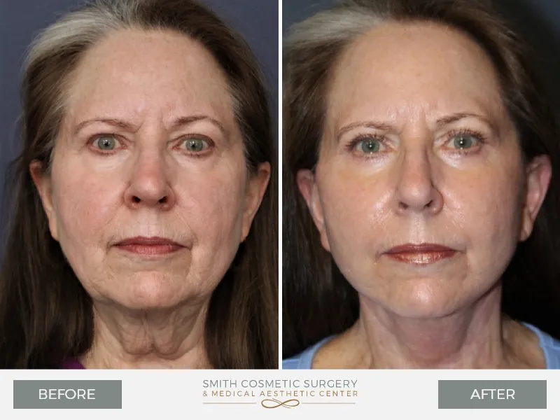 Before_and_After_ST_Facelift_front.jpg
