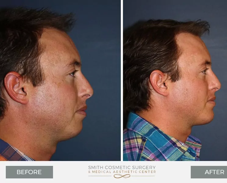 Chin-Surgery-1.jpg