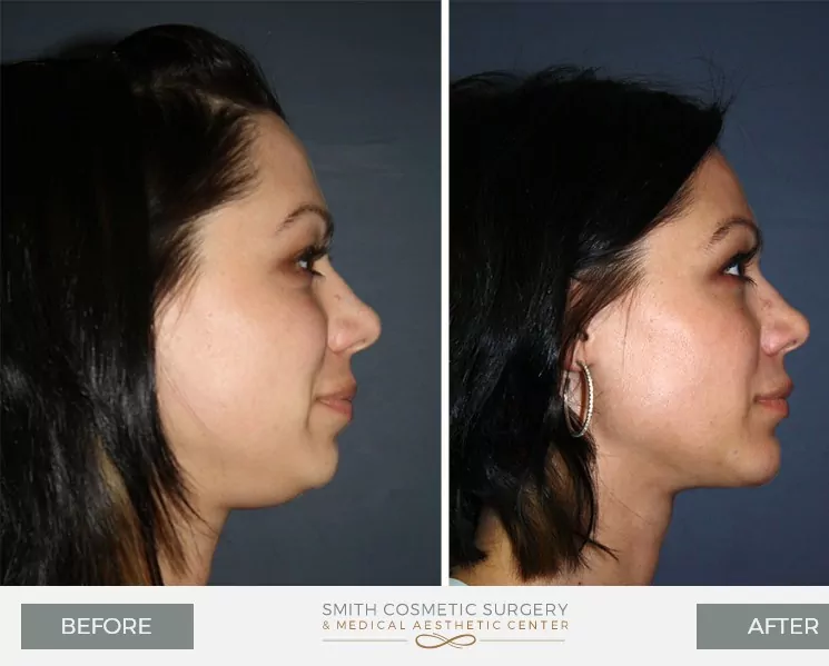Chin-Surgery-2.jpg