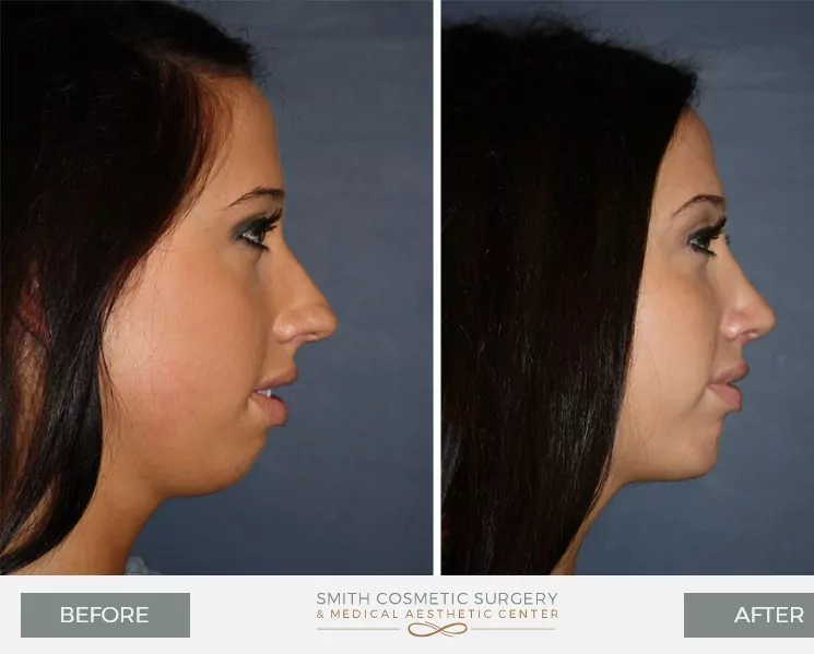 Chin-Surgery-3.jpg