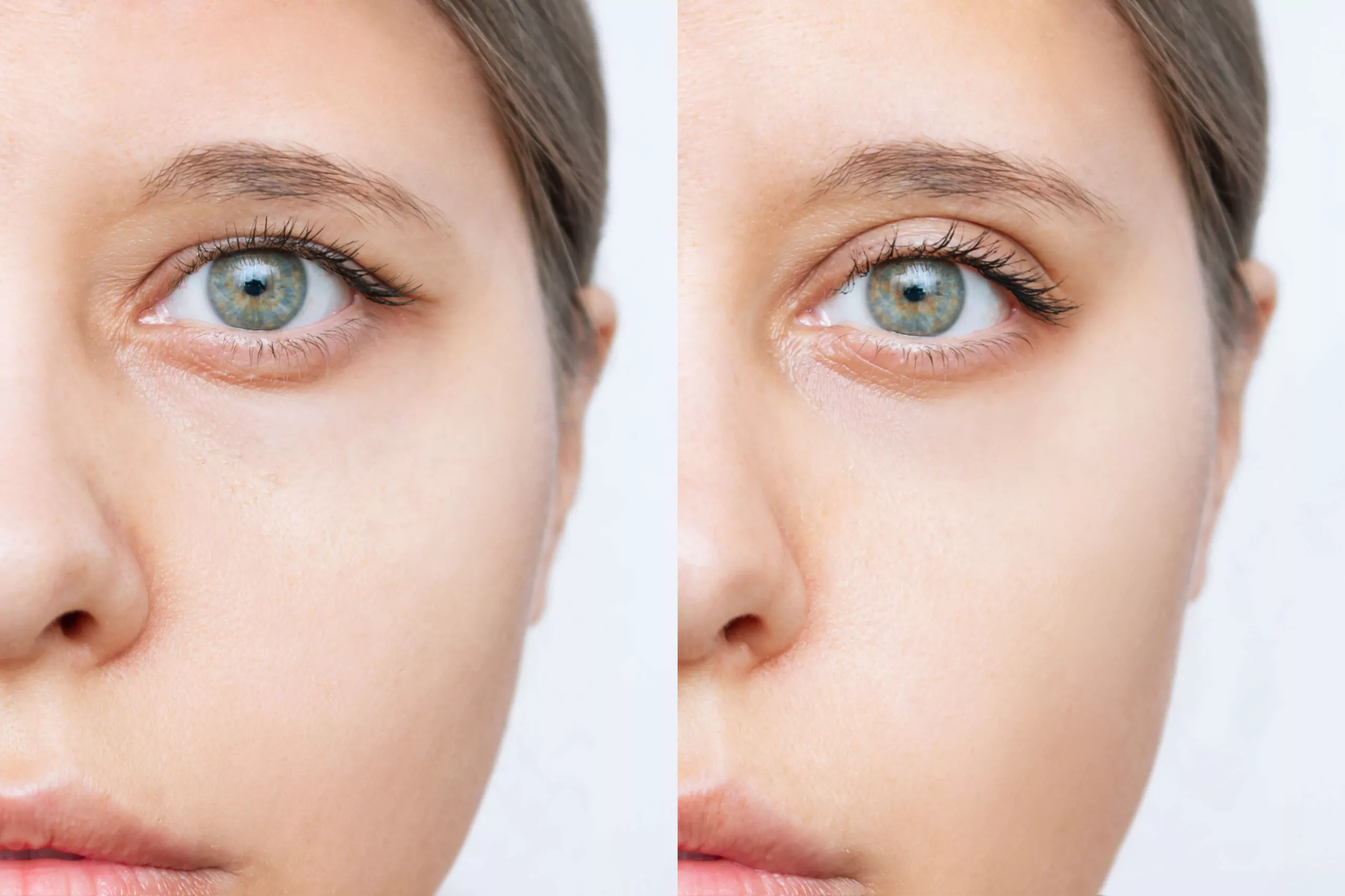 DENVER-EYELID-LIFTS-AND-BROW-LIFTS