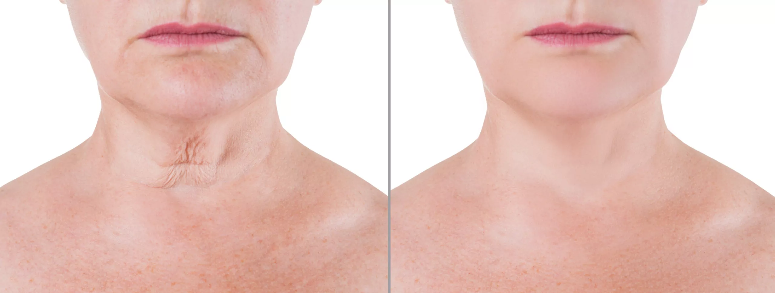 Skin rejuvenation on the neck, before after anti aging concept, wrinkle treatment, facelift and plastic surgery, half of body isolated on white background