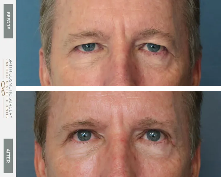 DF-Eyelid-and-Brow-Lift-Front.jpg