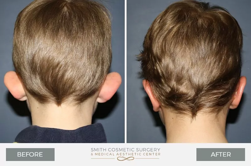 Ear-Surgery-3.jpg