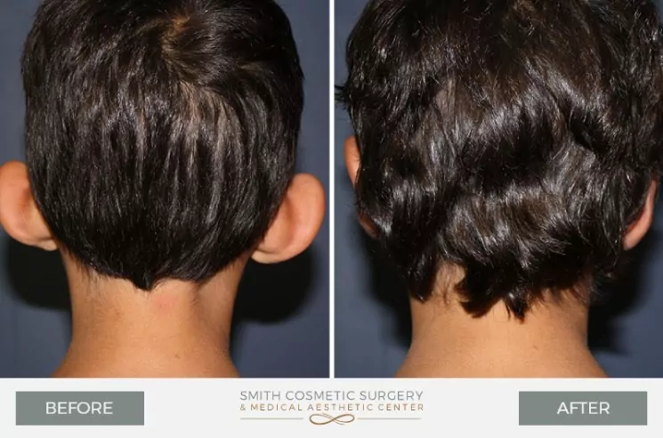 Ear-Surgery-4.jpg