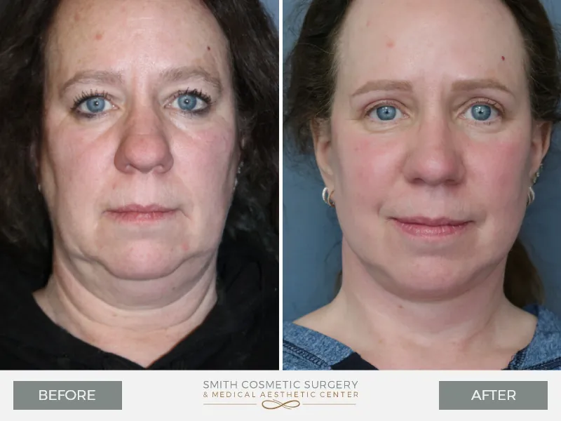 Facelift_before_after-1.jpg