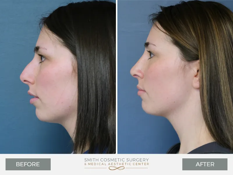 KQ-Rhinoplasty-Lateral-Left.jpg