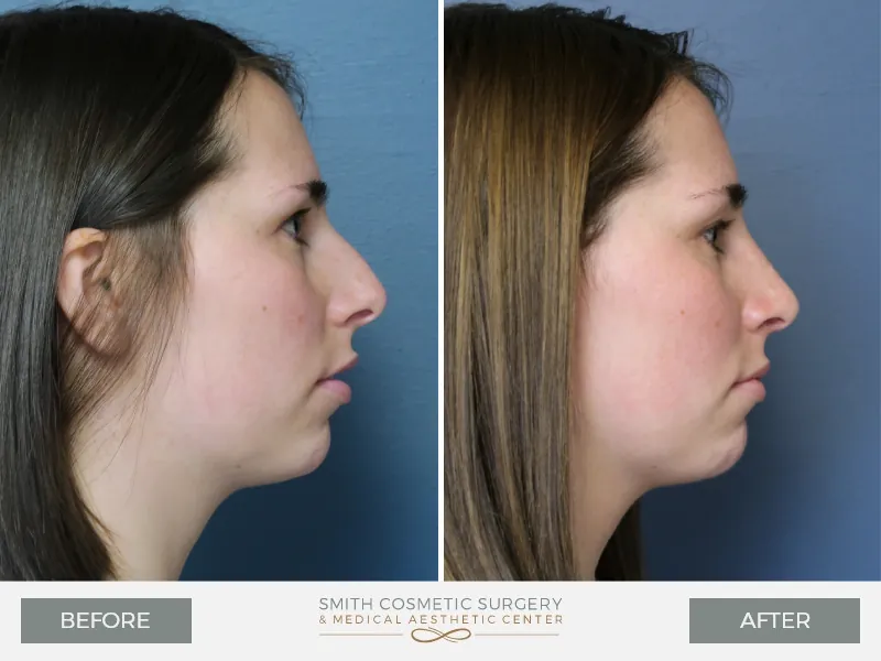 KQ-Rhinoplasty-Lateral-Right.jpg