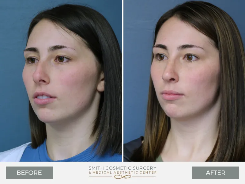 KQ-Rhinoplasty-Oblique-Left.jpg