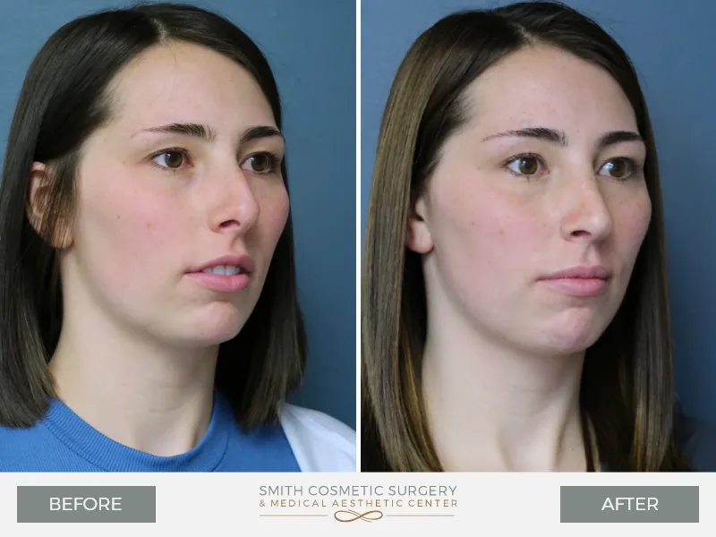 KQ-Rhinoplasty-Oblique-Right.jpg