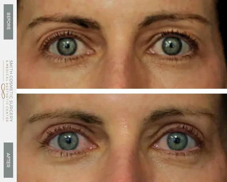 LS-Eyelid-and-Brow-Lift-Front.jpg
