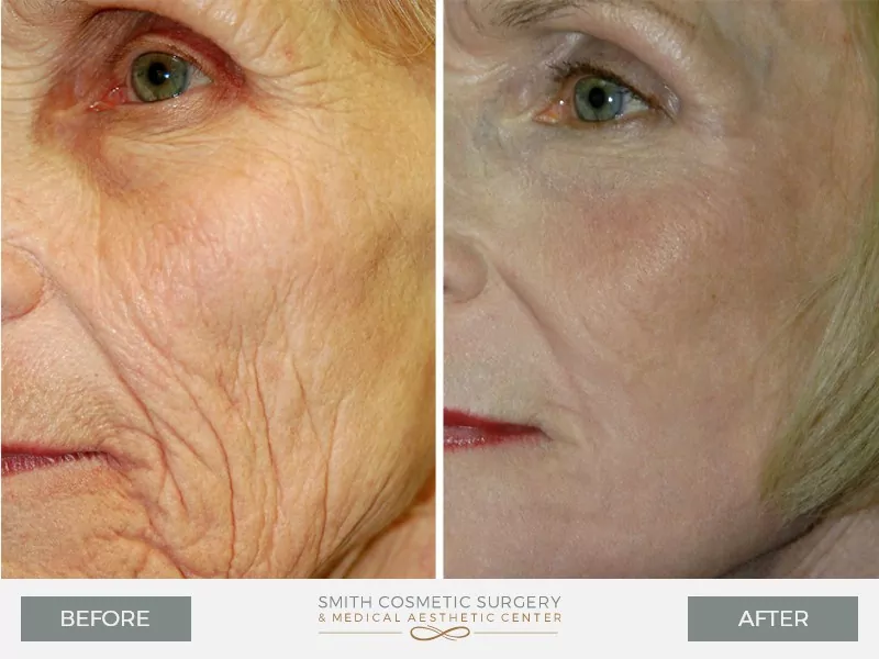 Laser-Resurfacing-1.jpg