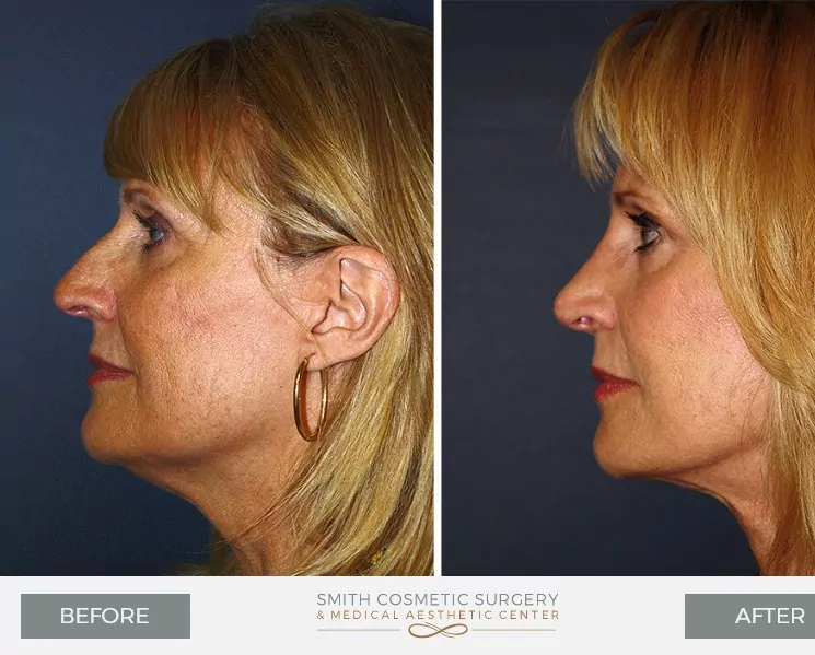 Nose-Surgery-1.jpg