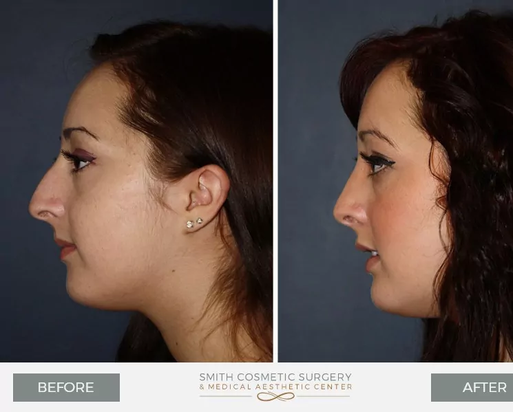 Nose-Surgery-2.jpg