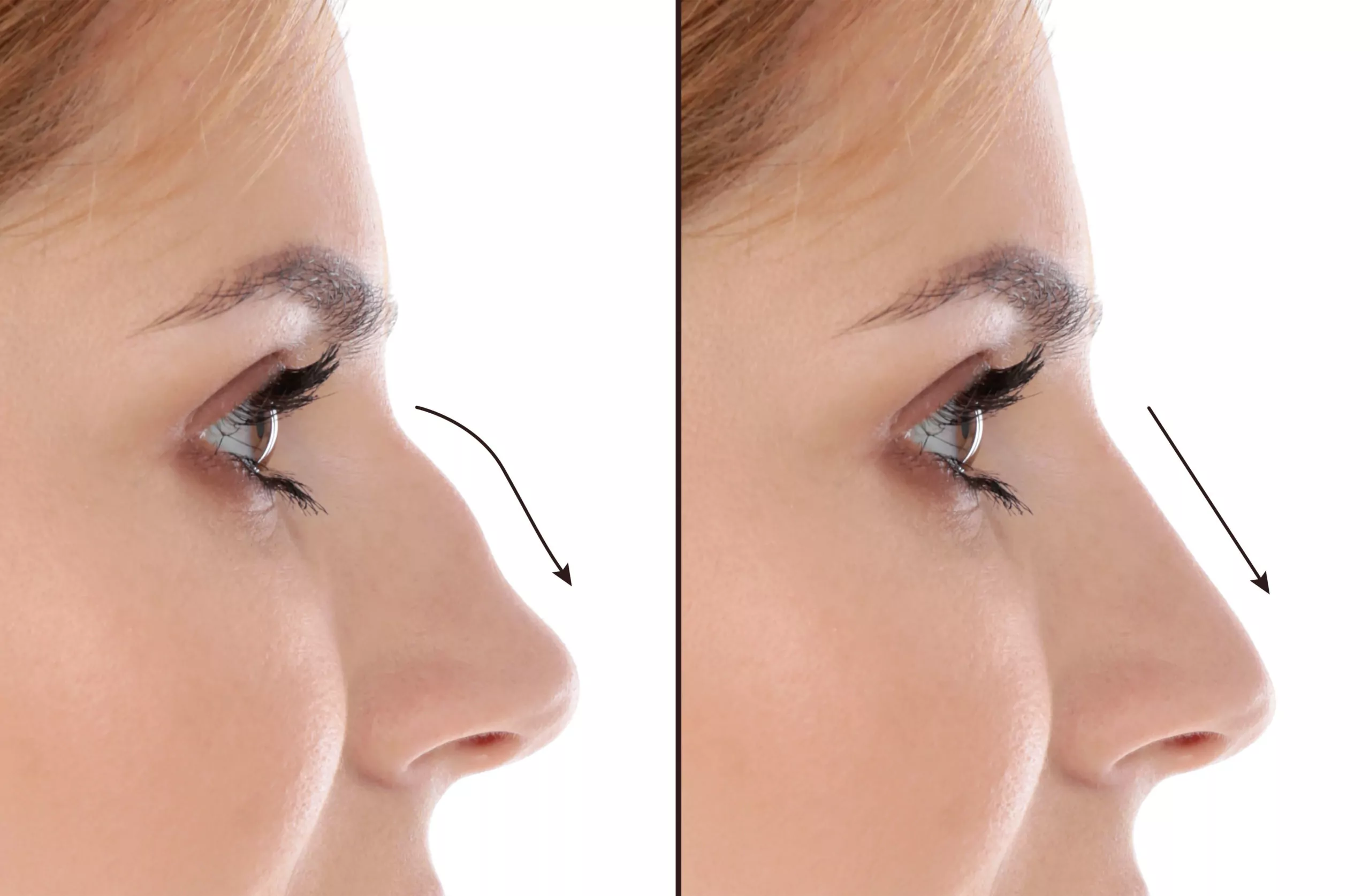 the rhinoplasty procedure