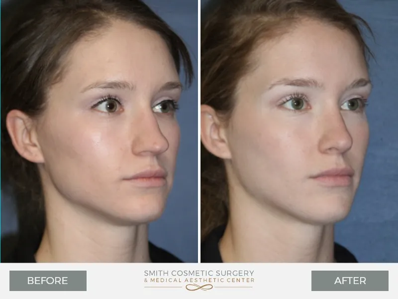 Rhinoplasty-Before-and-After.jpg