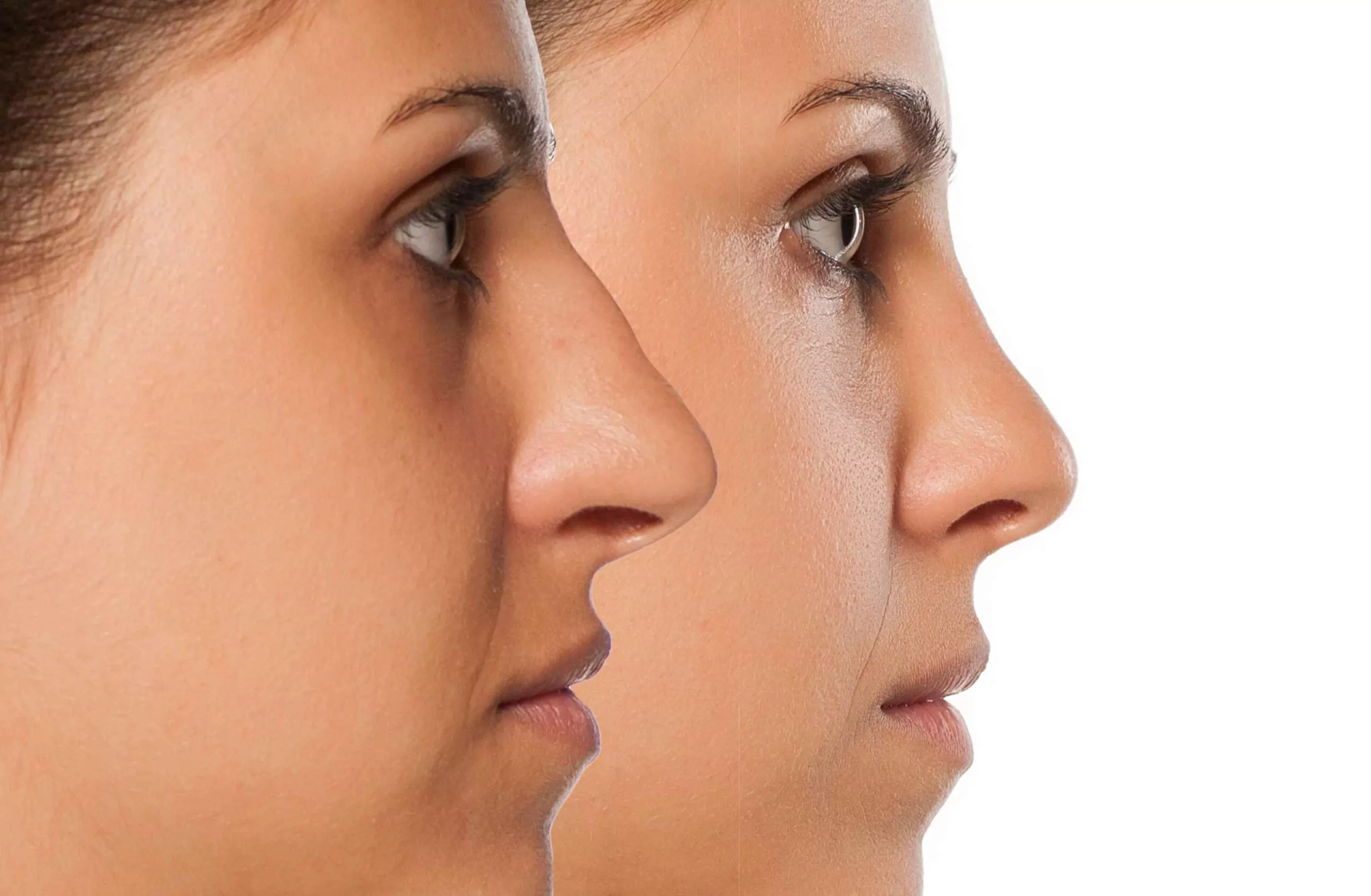 Nose Job (Rhinoplasty)