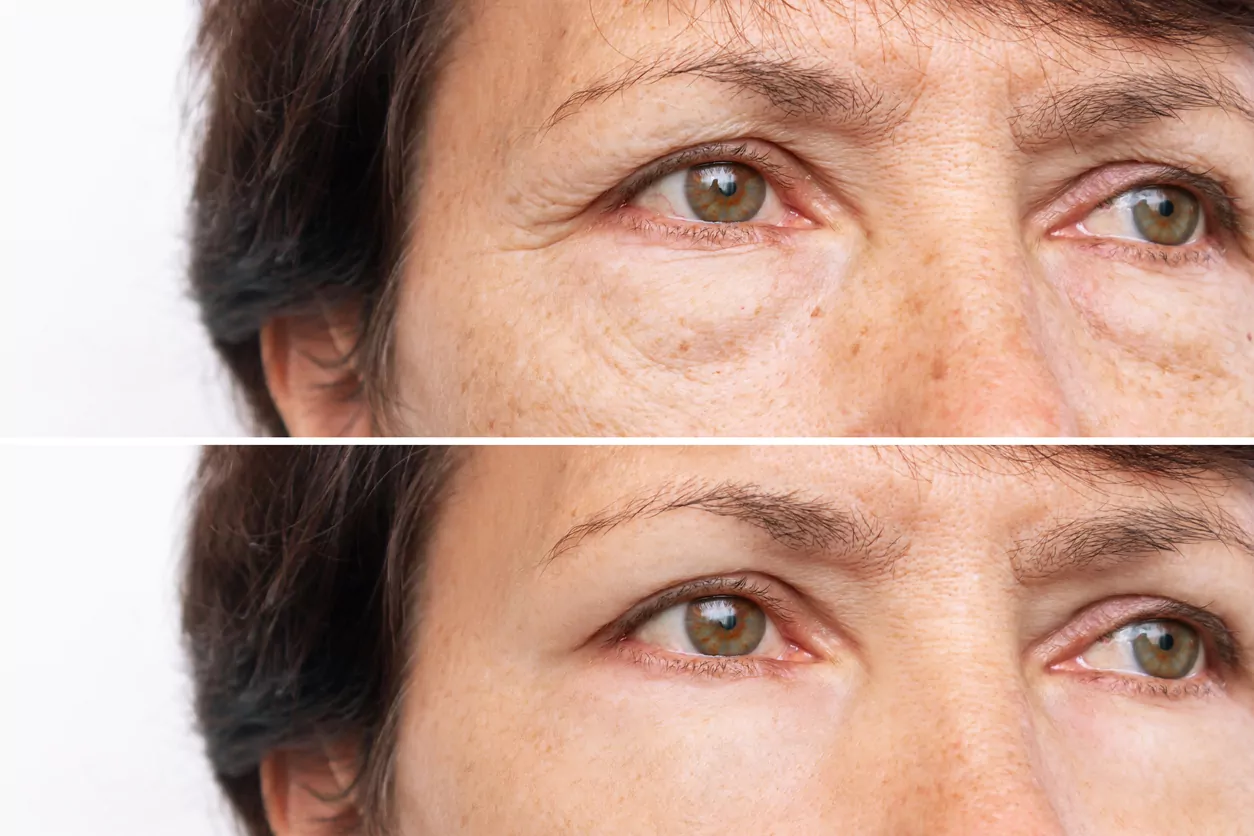 Lower Eyelid