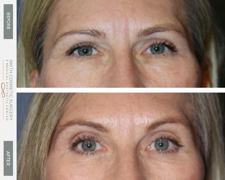 01_browlift_before_and_after.png