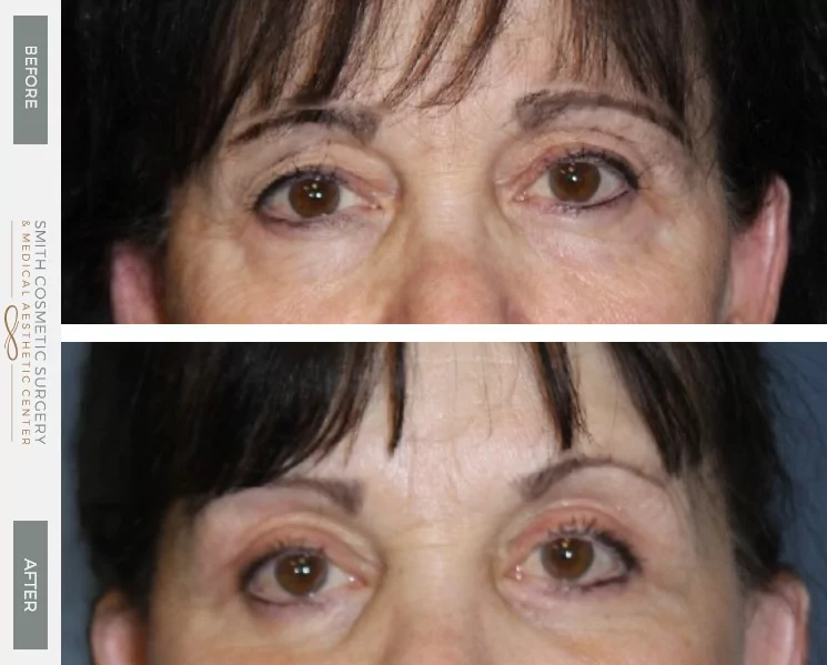 03._browlift_before_and_after.png