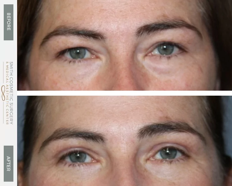 04_browlift_before_and_after.png