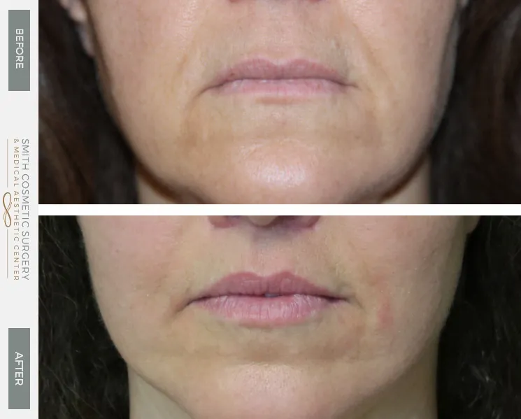 JH-Lip-Lift-Front.jpg