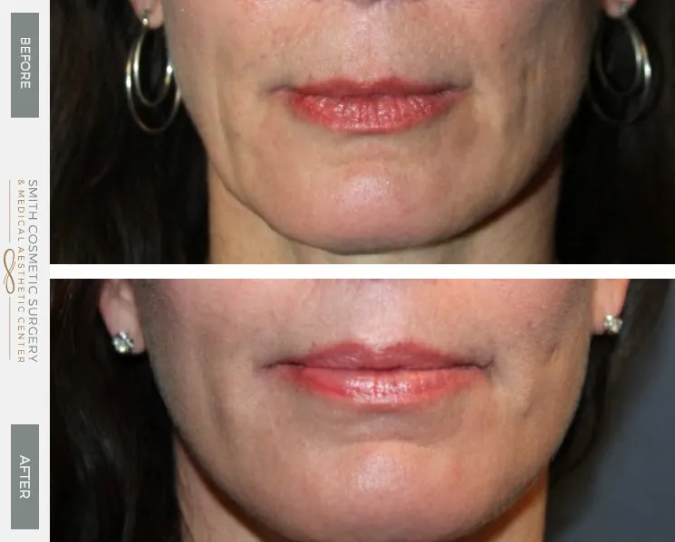 Lip-Lift-Case-1.jpg