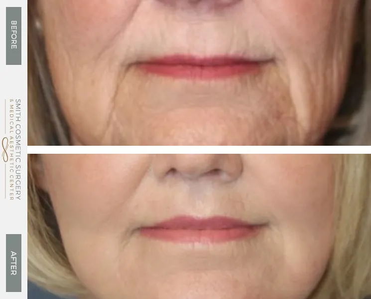 Lip-Lift-Case-3.jpg