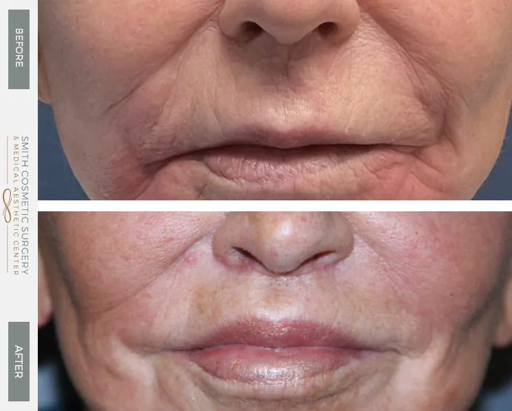 lip_lift_before_and_after-1.jpg